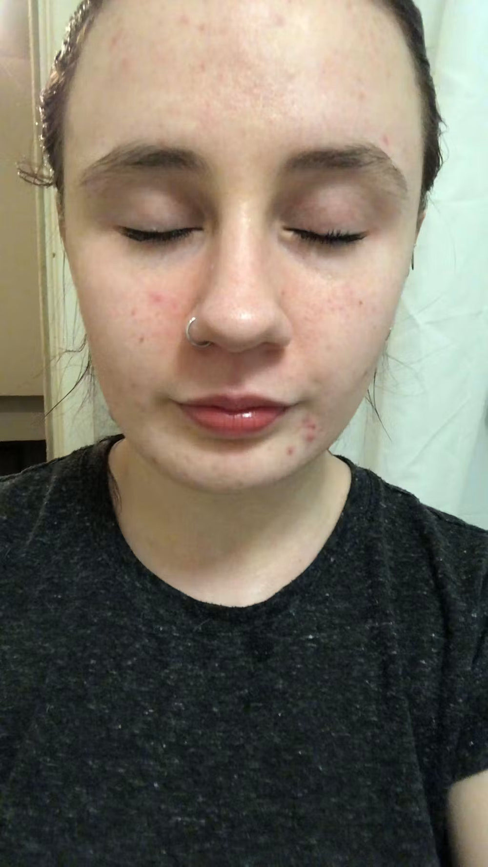 acne NL keep