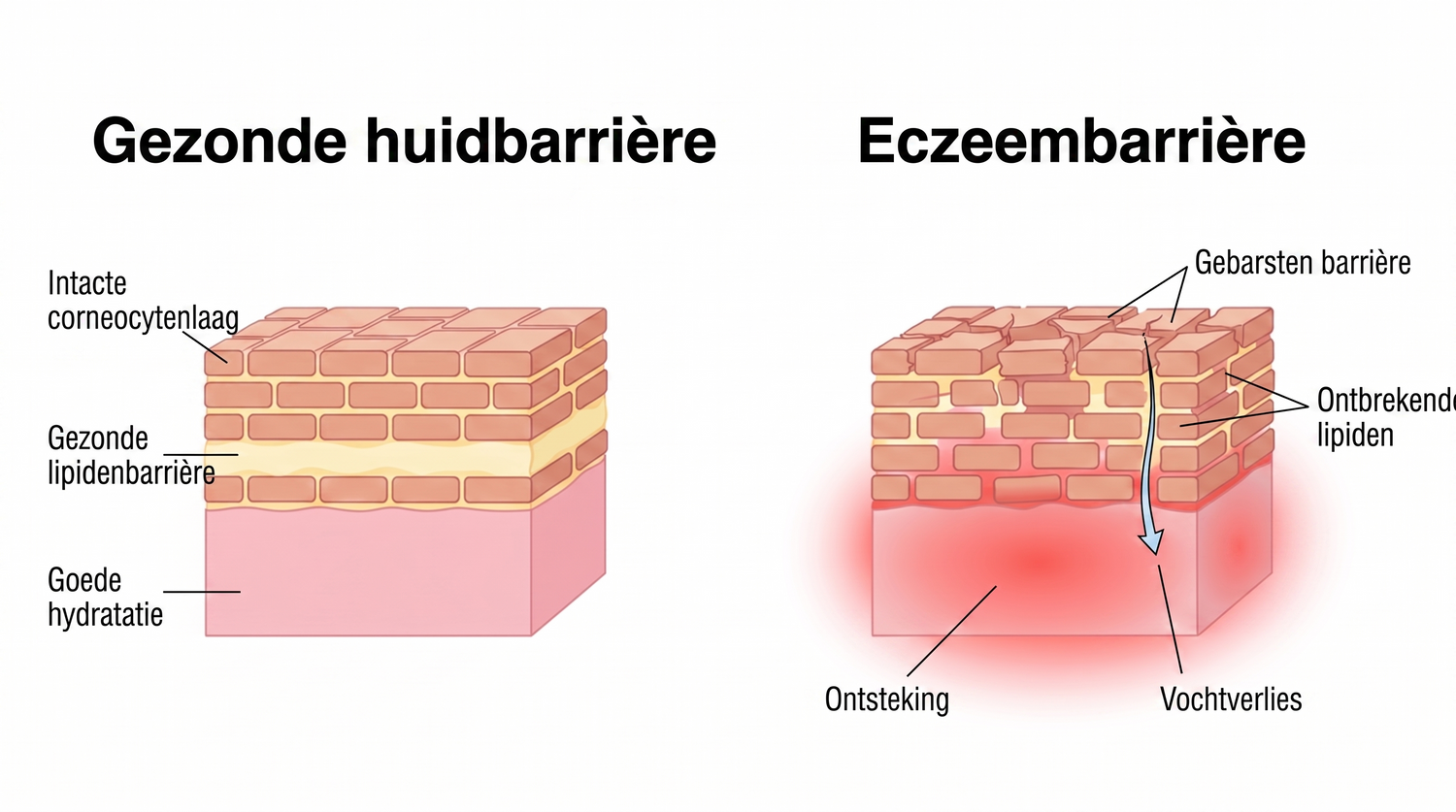 eczema_NL_skin_barrier_v2.png