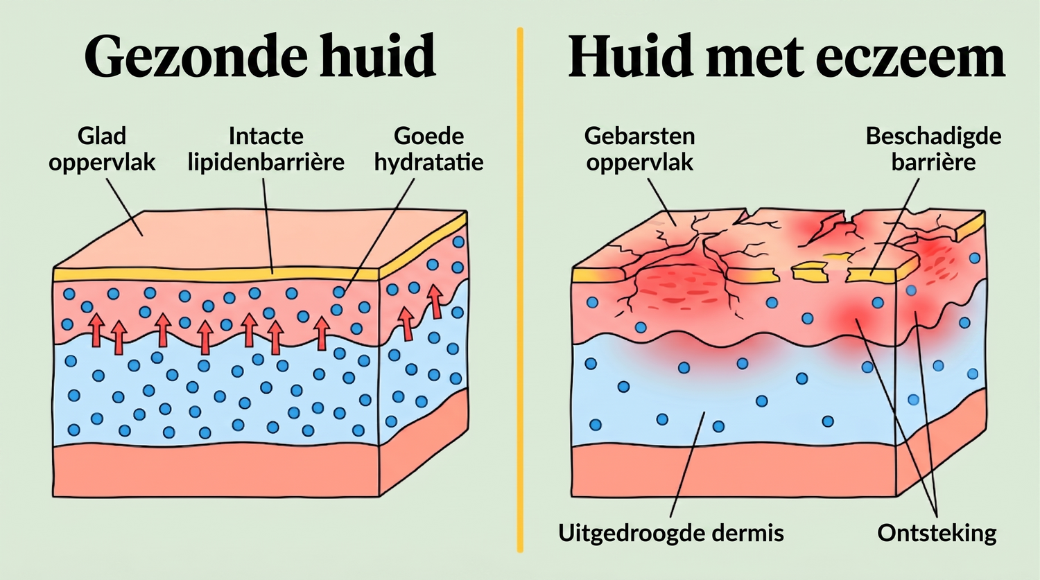 eczema_NL_skin_layers_v2.png